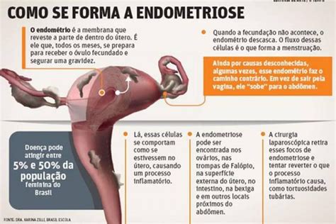 endometriose gravidez